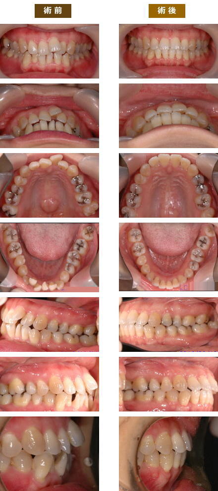 矯正歯科 | ひぐち歯科 – 笑顔は口元から（公式ページ）長崎市