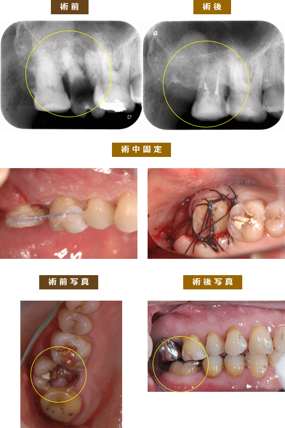 自家歯牙移植 - 健康/医学