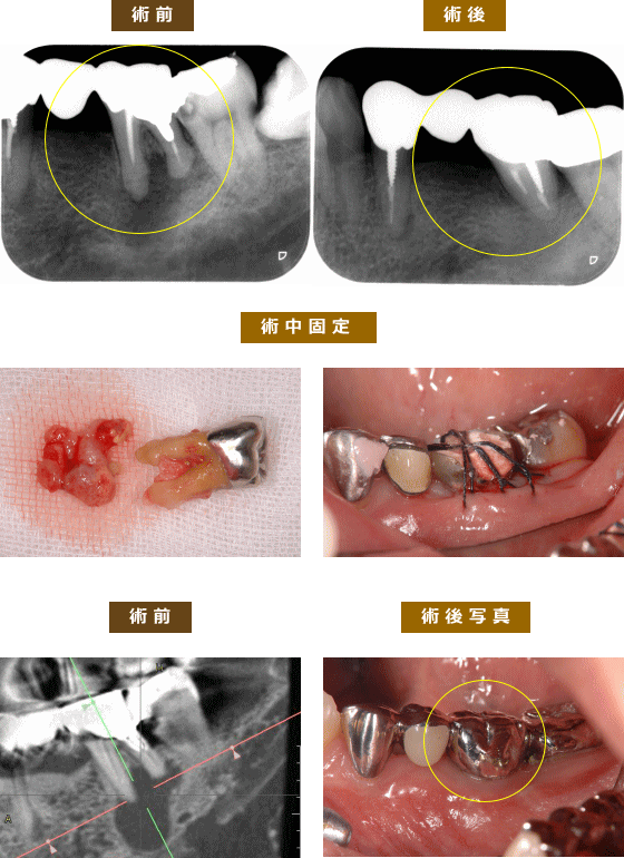 自家歯牙移植 | ひぐち歯科 – 笑顔は口元から（公式ページ）長崎市