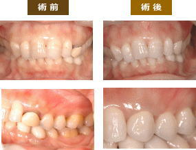 ホワイトニングとメタルボンド画像
