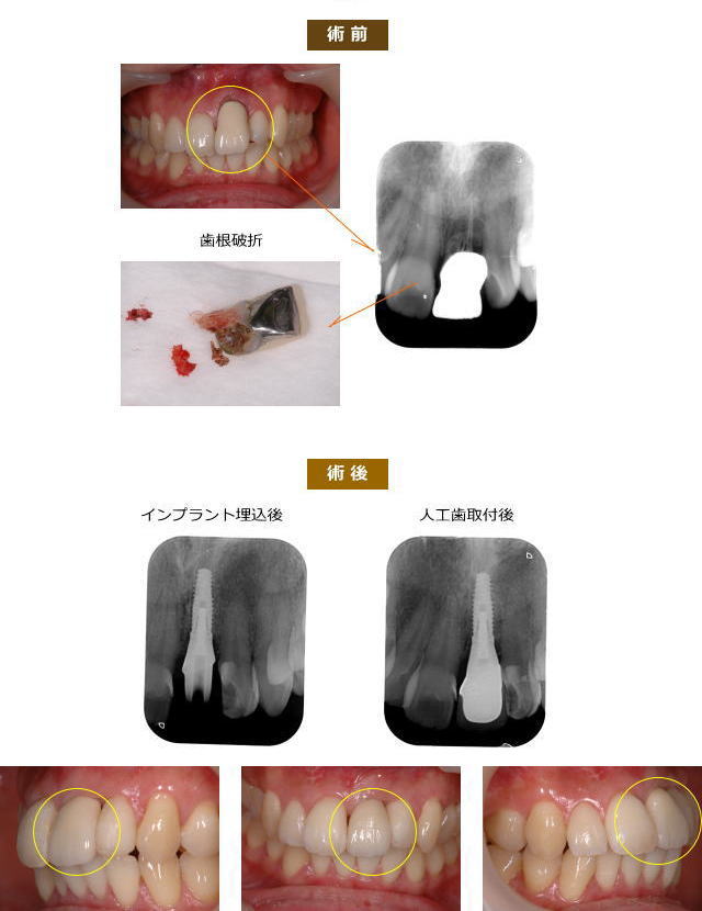 インプラント症例１