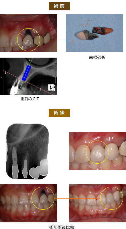 インプラント症例２