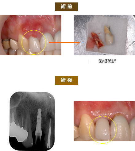 インプラント症例３