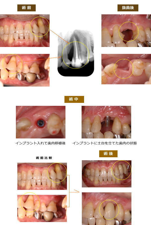 インプラント症例４