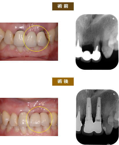 インプラント症例５