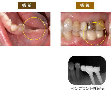 インプラント症例６