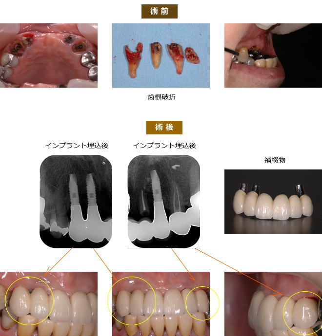 インプラント症例７