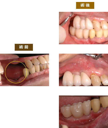 インプラント症例８