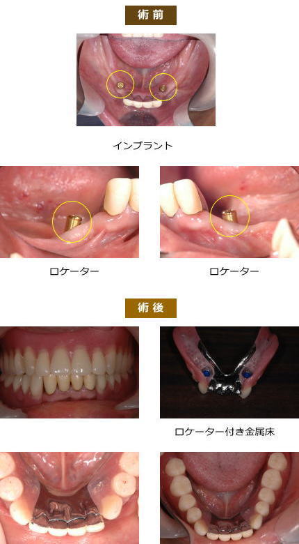 インプラント症例９