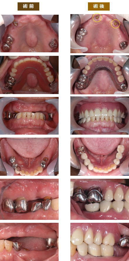 インプラント症例１１