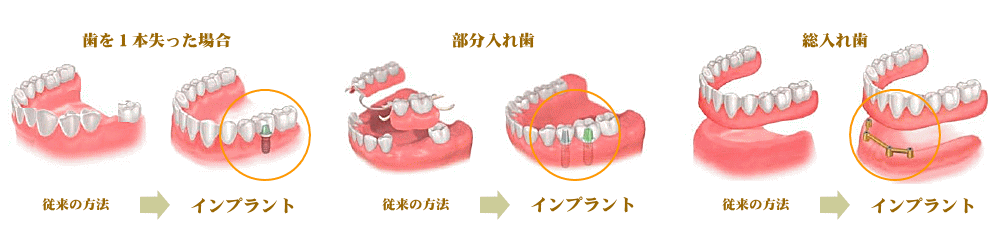 インプラント治療のメリット