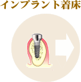 インプラント治療の流れ3