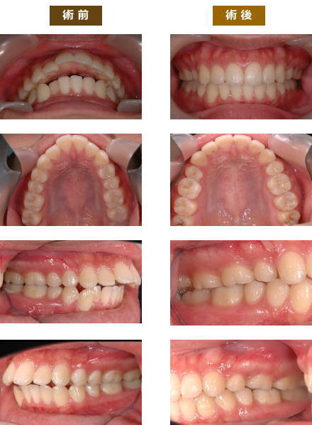 矯正症例１