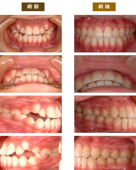 矯正症例４