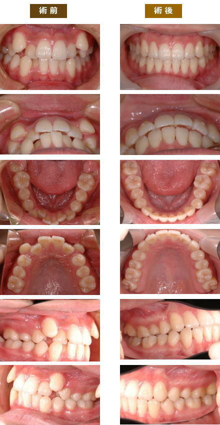 矯正症例２