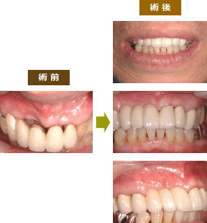 歯肉増大術とメタルボンドブリッジ画像